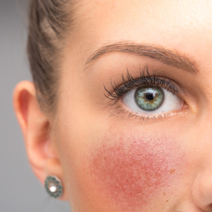 Peau sensible avec rougeurs et pores visibles – sérum naturel apaisant